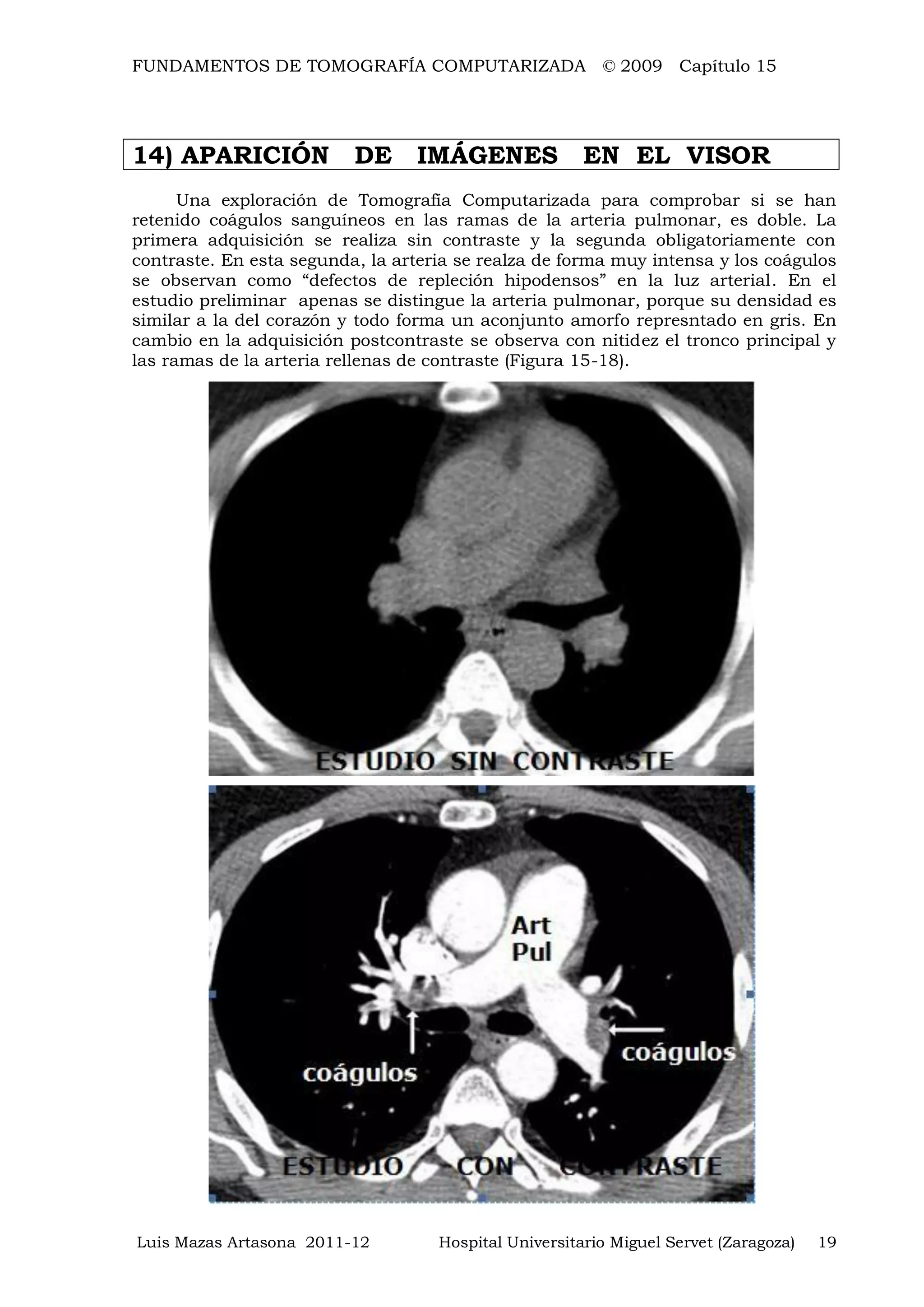 FUNDAMENTOS DE TOMOGRAFÍA COMPUTARIZADA © 2009 Capítulo 15
Luis Mazas Artasona 2011-12 Hospital Universitario Miguel Servet (Zaragoza) 19
14) APARICIÓN DE IMÁGENES EN EL VISOR
Una exploración de Tomografía Computarizada para comprobar si se han
retenido coágulos sanguíneos en las ramas de la arteria pulmonar, es doble. La
primera adquisición se realiza sin contraste y la segunda obligatoriamente con
contraste. En esta segunda, la arteria se realza de forma muy intensa y los coágulos
se observan como “defectos de repleción hipodensos” en la luz arterial. En el
estudio preliminar apenas se distingue la arteria pulmonar, porque su densidad es
similar a la del corazón y todo forma un aconjunto amorfo represntado en gris. En
cambio en la adquisición postcontraste se observa con nitidez el tronco principal y
las ramas de la arteria rellenas de contraste (Figura 15-18).
 