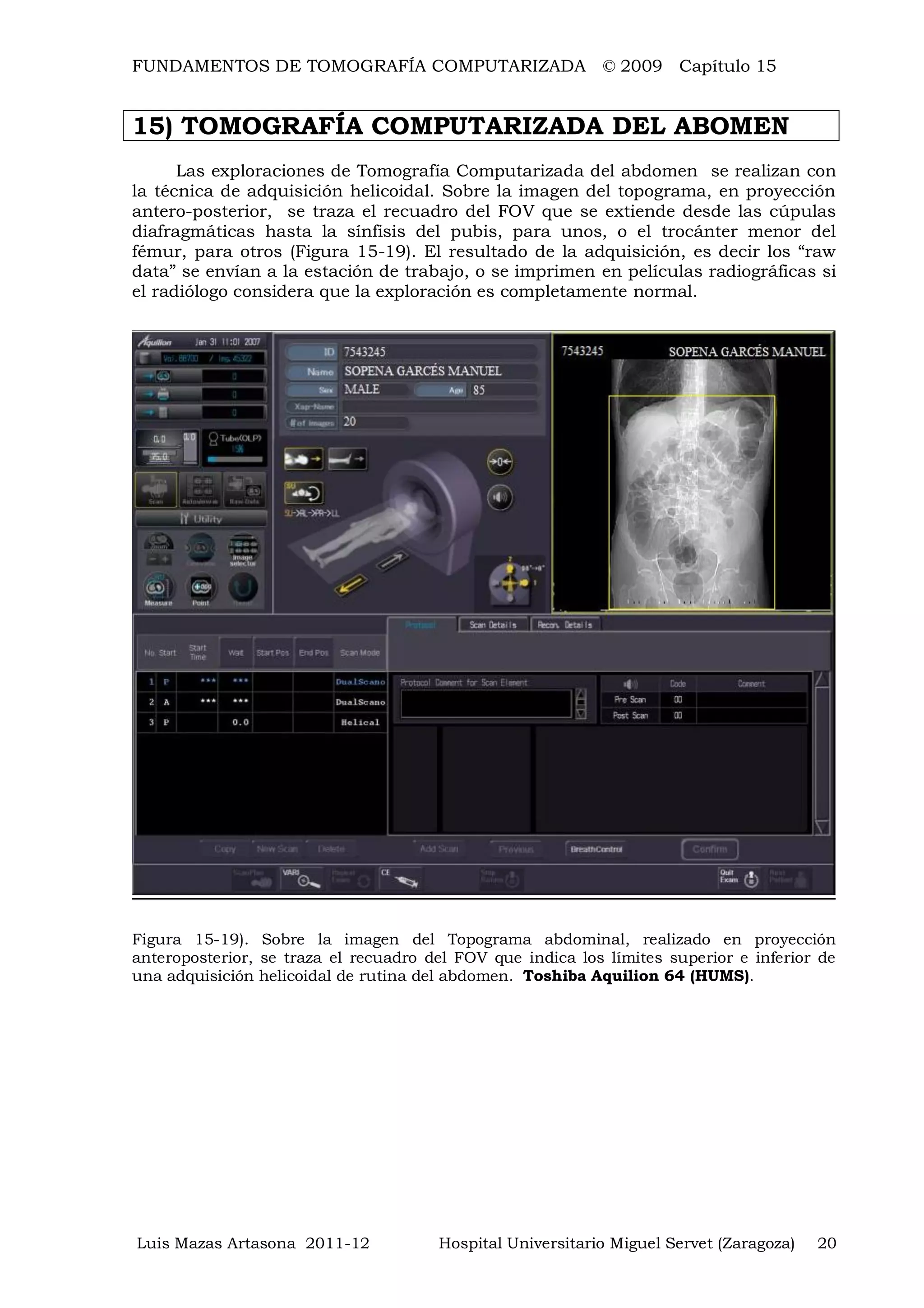 FUNDAMENTOS DE TOMOGRAFÍA COMPUTARIZADA © 2009 Capítulo 15
Luis Mazas Artasona 2011-12 Hospital Universitario Miguel Servet (Zaragoza) 20
15) TOMOGRAFÍA COMPUTARIZADA DEL ABOMEN
Las exploraciones de Tomografía Computarizada del abdomen se realizan con
la técnica de adquisición helicoidal. Sobre la imagen del topograma, en proyección
antero-posterior, se traza el recuadro del FOV que se extiende desde las cúpulas
diafragmáticas hasta la sínfisis del pubis, para unos, o el trocánter menor del
fémur, para otros (Figura 15-19). El resultado de la adquisición, es decir los “raw
data” se envían a la estación de trabajo, o se imprimen en películas radiográficas si
el radiólogo considera que la exploración es completamente normal.
Figura 15-19). Sobre la imagen del Topograma abdominal, realizado en proyección
anteroposterior, se traza el recuadro del FOV que indica los límites superior e inferior de
una adquisición helicoidal de rutina del abdomen. Toshiba Aquilion 64 (HUMS).
 