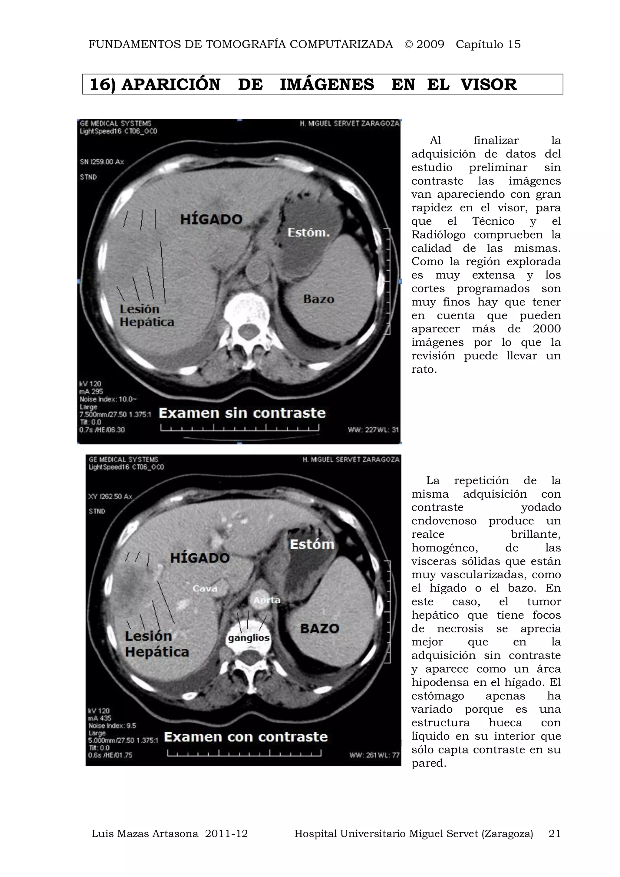 FUNDAMENTOS DE TOMOGRAFÍA COMPUTARIZADA © 2009 Capítulo 15
Luis Mazas Artasona 2011-12 Hospital Universitario Miguel Servet (Zaragoza) 21
16) APARICIÓN DE IMÁGENES EN EL VISOR
Al finalizar la
adquisición de datos del
estudio preliminar sin
contraste las imágenes
van apareciendo con gran
rapidez en el visor, para
que el Técnico y el
Radiólogo comprueben la
calidad de las mismas.
Como la región explorada
es muy extensa y los
cortes programados son
muy finos hay que tener
en cuenta que pueden
aparecer más de 2000
imágenes por lo que la
revisión puede llevar un
rato.
La repetición de la
misma adquisición con
contraste yodado
endovenoso produce un
realce brillante,
homogéneo, de las
vísceras sólidas que están
muy vascularizadas, como
el hígado o el bazo. En
este caso, el tumor
hepático que tiene focos
de necrosis se aprecia
mejor que en la
adquisición sin contraste
y aparece como un área
hipodensa en el hígado. El
estómago apenas ha
variado porque es una
estructura hueca con
líquido en su interior que
sólo capta contraste en su
pared.
 