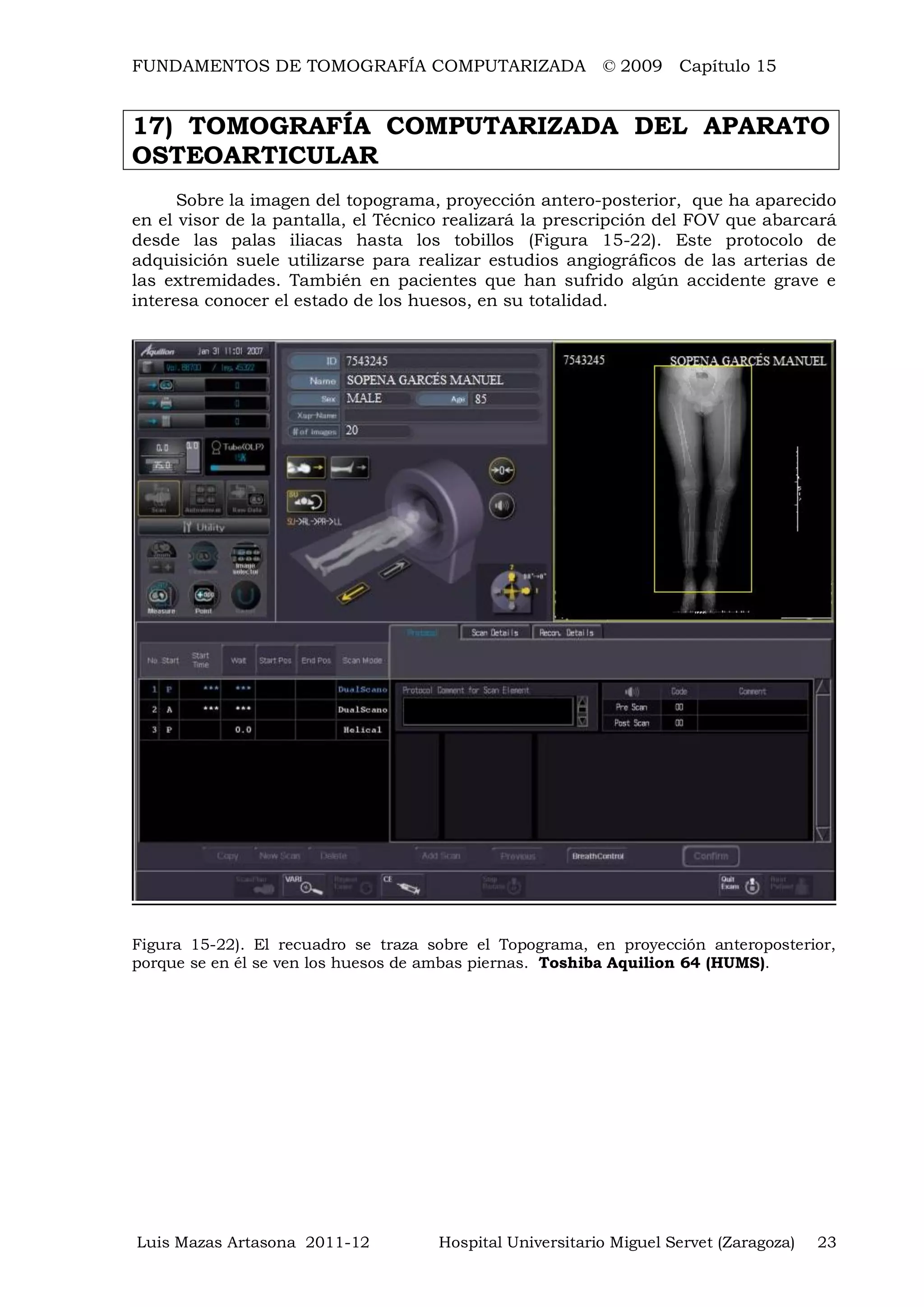 FUNDAMENTOS DE TOMOGRAFÍA COMPUTARIZADA © 2009 Capítulo 15
Luis Mazas Artasona 2011-12 Hospital Universitario Miguel Servet (Zaragoza) 23
17) TOMOGRAFÍA COMPUTARIZADA DEL APARATO
OSTEOARTICULAR
Sobre la imagen del topograma, proyección antero-posterior, que ha aparecido
en el visor de la pantalla, el Técnico realizará la prescripción del FOV que abarcará
desde las palas iliacas hasta los tobillos (Figura 15-22). Este protocolo de
adquisición suele utilizarse para realizar estudios angiográficos de las arterias de
las extremidades. También en pacientes que han sufrido algún accidente grave e
interesa conocer el estado de los huesos, en su totalidad.
Figura 15-22). El recuadro se traza sobre el Topograma, en proyección anteroposterior,
porque se en él se ven los huesos de ambas piernas. Toshiba Aquilion 64 (HUMS).
 