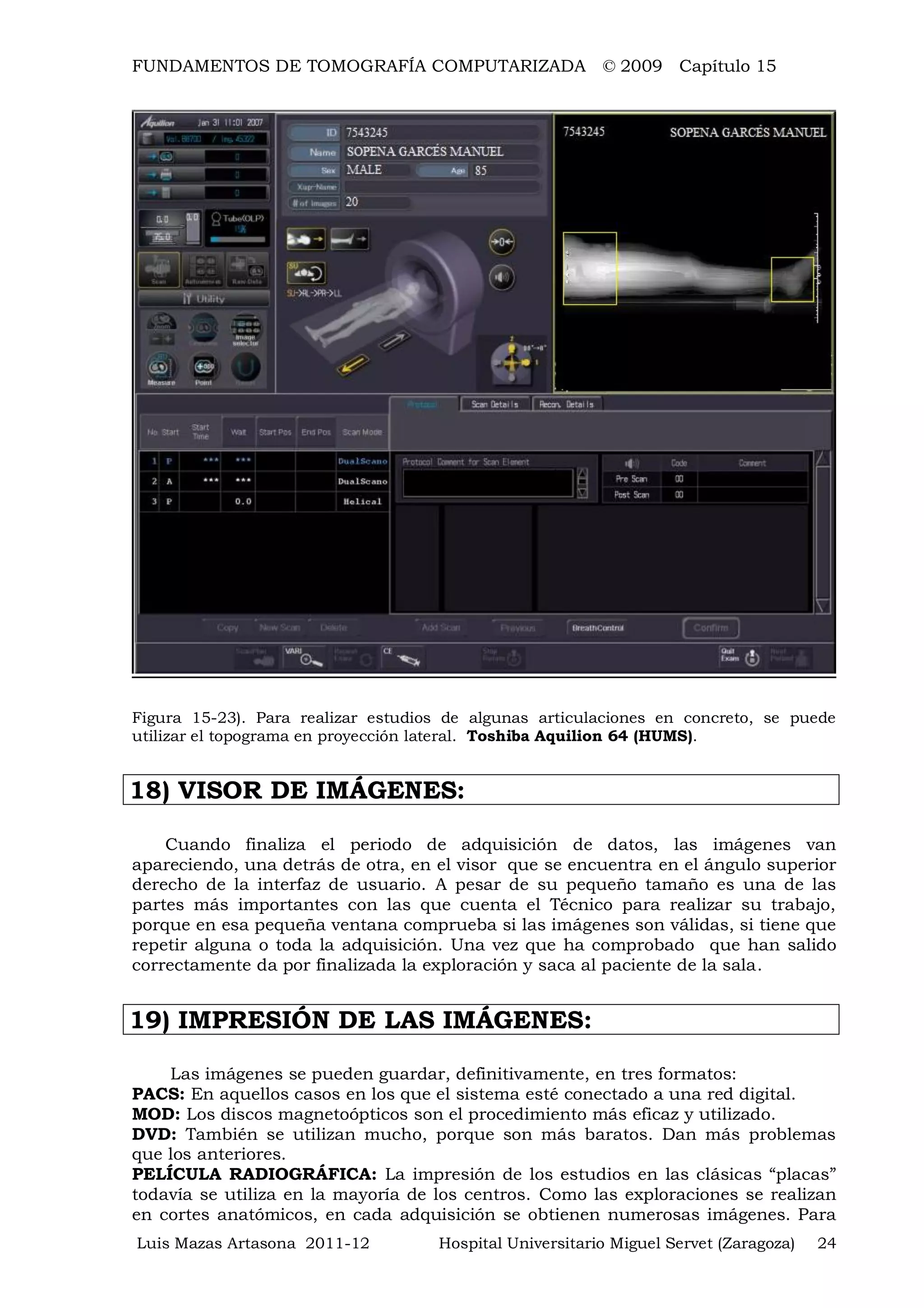 FUNDAMENTOS DE TOMOGRAFÍA COMPUTARIZADA © 2009 Capítulo 15
Luis Mazas Artasona 2011-12 Hospital Universitario Miguel Servet (Zaragoza) 24
Figura 15-23). Para realizar estudios de algunas articulaciones en concreto, se puede
utilizar el topograma en proyección lateral. Toshiba Aquilion 64 (HUMS).
18) VISOR DE IMÁGENES:
Cuando finaliza el periodo de adquisición de datos, las imágenes van
apareciendo, una detrás de otra, en el visor que se encuentra en el ángulo superior
derecho de la interfaz de usuario. A pesar de su pequeño tamaño es una de las
partes más importantes con las que cuenta el Técnico para realizar su trabajo,
porque en esa pequeña ventana comprueba si las imágenes son válidas, si tiene que
repetir alguna o toda la adquisición. Una vez que ha comprobado que han salido
correctamente da por finalizada la exploración y saca al paciente de la sala.
19) IMPRESIÓN DE LAS IMÁGENES:
Las imágenes se pueden guardar, definitivamente, en tres formatos:
PACS: En aquellos casos en los que el sistema esté conectado a una red digital.
MOD: Los discos magnetoópticos son el procedimiento más eficaz y utilizado.
DVD: También se utilizan mucho, porque son más baratos. Dan más problemas
que los anteriores.
PELÍCULA RADIOGRÁFICA: La impresión de los estudios en las clásicas “placas”
todavía se utiliza en la mayoría de los centros. Como las exploraciones se realizan
en cortes anatómicos, en cada adquisición se obtienen numerosas imágenes. Para
 