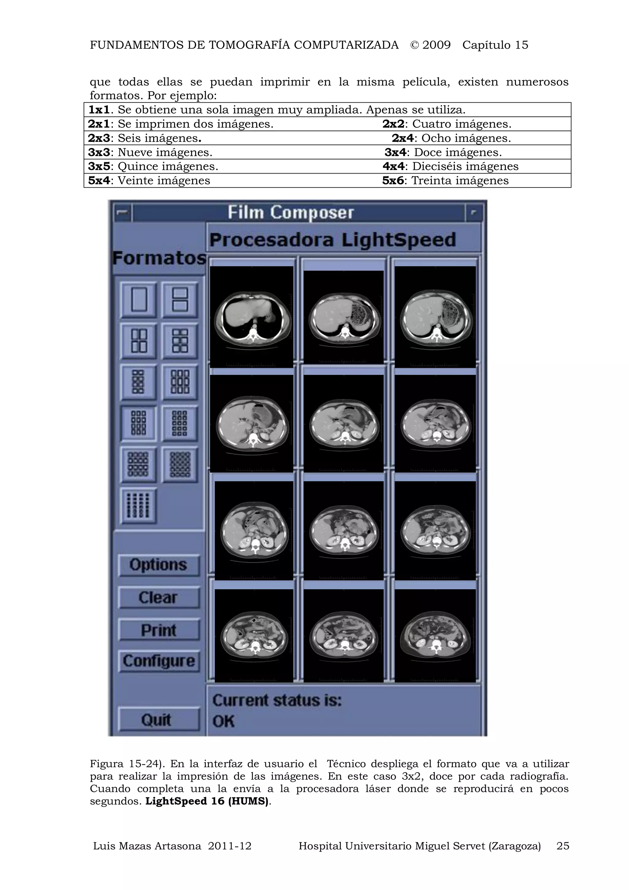 FUNDAMENTOS DE TOMOGRAFÍA COMPUTARIZADA © 2009 Capítulo 15
Luis Mazas Artasona 2011-12 Hospital Universitario Miguel Servet (Zaragoza) 25
que todas ellas se puedan imprimir en la misma película, existen numerosos
formatos. Por ejemplo:
1x1. Se obtiene una sola imagen muy ampliada. Apenas se utiliza.
2x1: Se imprimen dos imágenes. 2x2: Cuatro imágenes.
2x3: Seis imágenes. 2x4: Ocho imágenes.
3x3: Nueve imágenes. 3x4: Doce imágenes.
3x5: Quince imágenes. 4x4: Dieciséis imágenes
5x4: Veinte imágenes 5x6: Treinta imágenes
Figura 15-24). En la interfaz de usuario el Técnico despliega el formato que va a utilizar
para realizar la impresión de las imágenes. En este caso 3x2, doce por cada radiografía.
Cuando completa una la envía a la procesadora láser donde se reproducirá en pocos
segundos. LightSpeed 16 (HUMS).
 