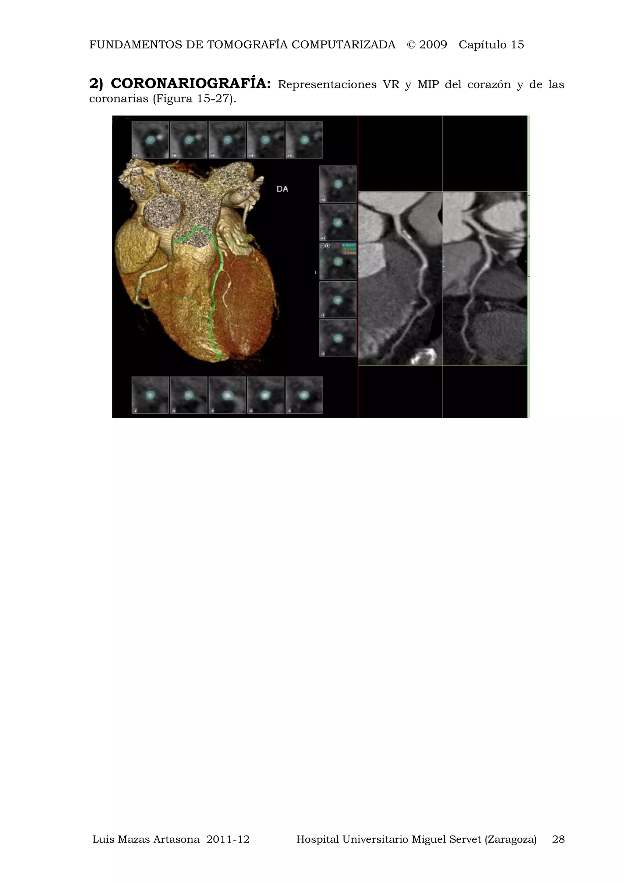 FUNDAMENTOS DE TOMOGRAFÍA COMPUTARIZADA © 2009 Capítulo 15
Luis Mazas Artasona 2011-12 Hospital Universitario Miguel Servet (Zaragoza) 28
2) CORONARIOGRAFÍA: Representaciones VR y MIP del corazón y de las
coronarias (Figura 15-27).
 