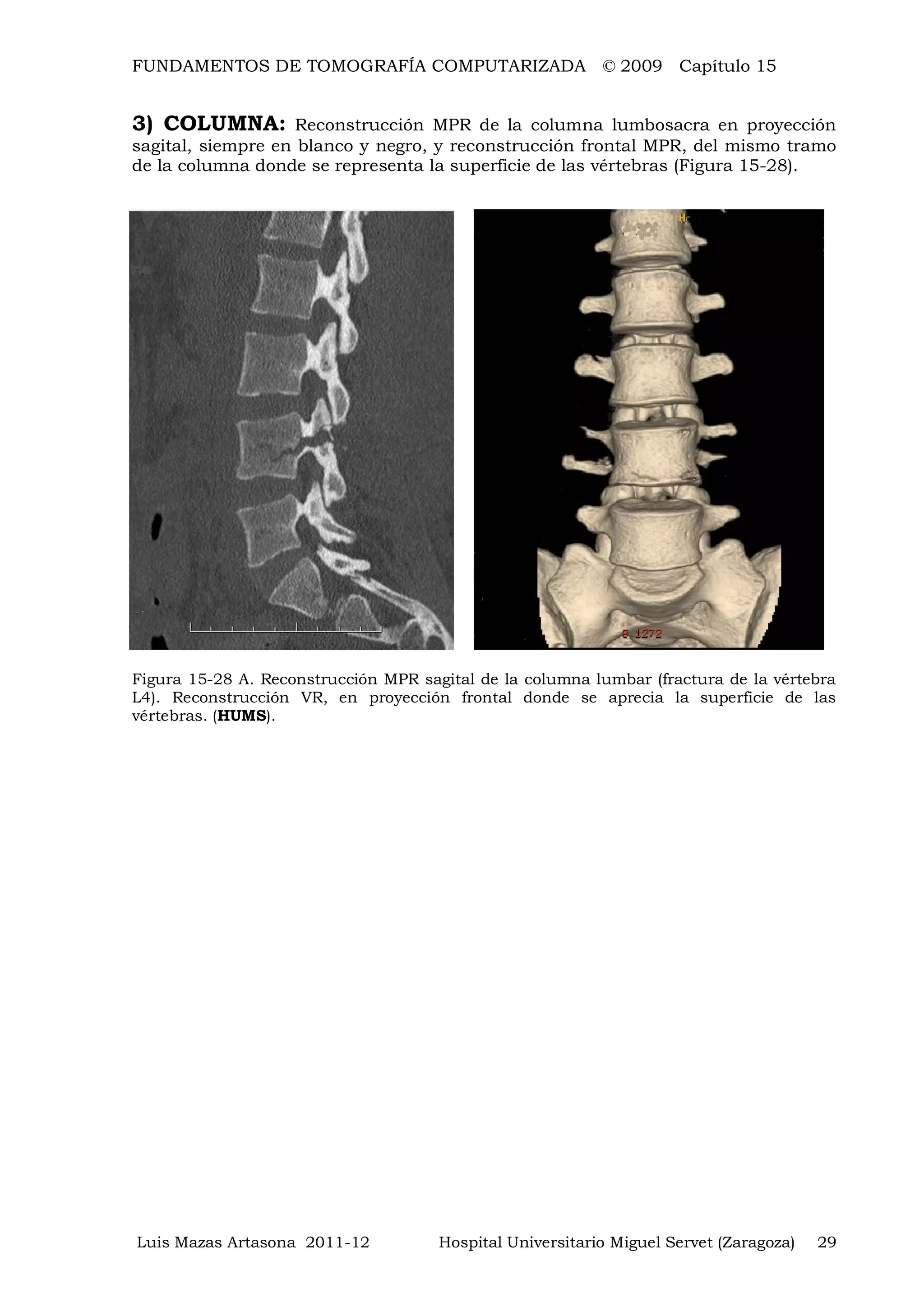 FUNDAMENTOS DE TOMOGRAFÍA COMPUTARIZADA © 2009 Capítulo 15
Luis Mazas Artasona 2011-12 Hospital Universitario Miguel Servet (Zaragoza) 29
3) COLUMNA: Reconstrucción MPR de la columna lumbosacra en proyección
sagital, siempre en blanco y negro, y reconstrucción frontal MPR, del mismo tramo
de la columna donde se representa la superficie de las vértebras (Figura 15-28).
Figura 15-28 A. Reconstrucción MPR sagital de la columna lumbar (fractura de la vértebra
L4). Reconstrucción VR, en proyección frontal donde se aprecia la superficie de las
vértebras. (HUMS).
 