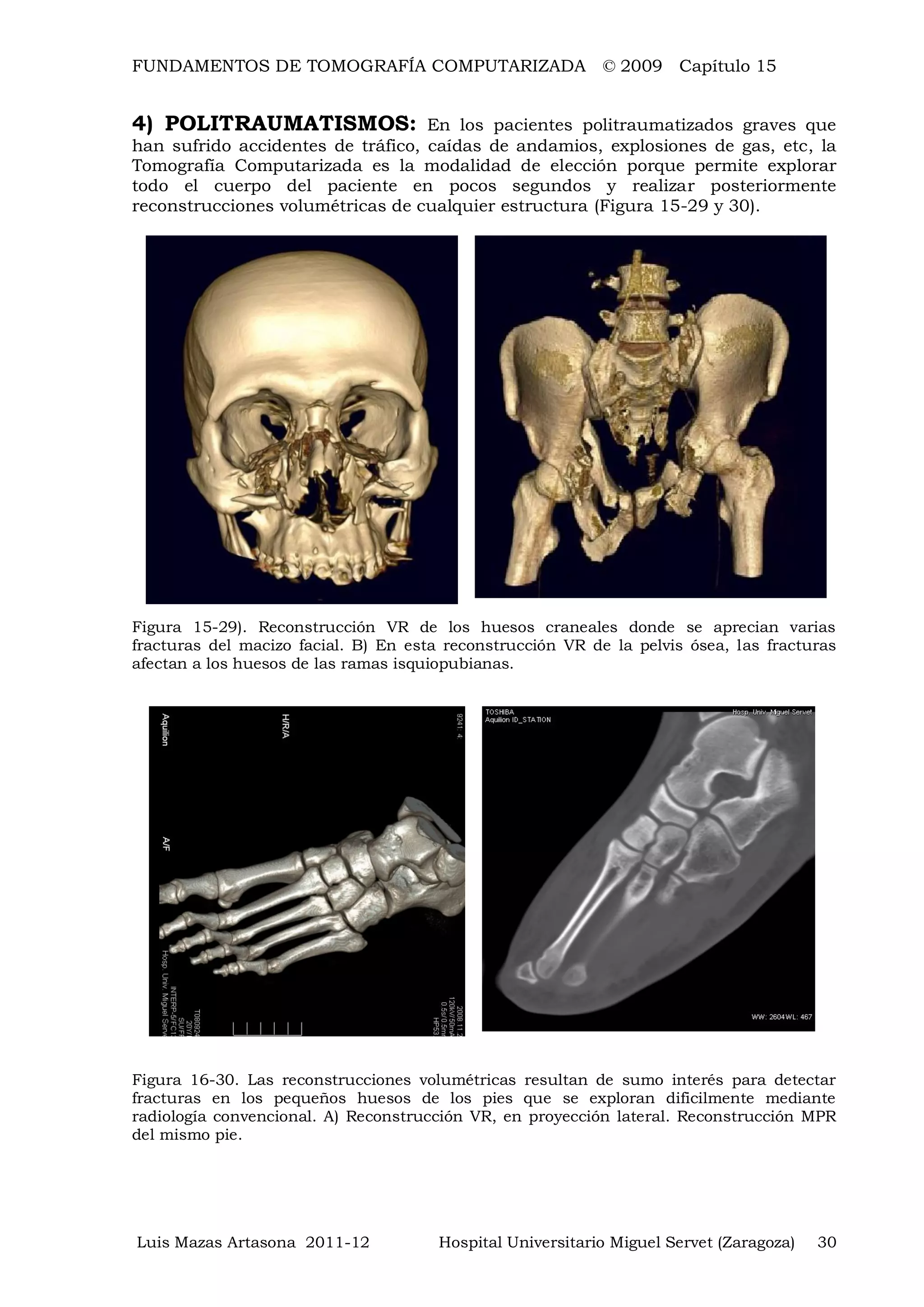 FUNDAMENTOS DE TOMOGRAFÍA COMPUTARIZADA © 2009 Capítulo 15
Luis Mazas Artasona 2011-12 Hospital Universitario Miguel Servet (Zaragoza) 30
4) POLITRAUMATISMOS: En los pacientes politraumatizados graves que
han sufrido accidentes de tráfico, caídas de andamios, explosiones de gas, etc, la
Tomografía Computarizada es la modalidad de elección porque permite explorar
todo el cuerpo del paciente en pocos segundos y realizar posteriormente
reconstrucciones volumétricas de cualquier estructura (Figura 15-29 y 30).
Figura 15-29). Reconstrucción VR de los huesos craneales donde se aprecian varias
fracturas del macizo facial. B) En esta reconstrucción VR de la pelvis ósea, las fracturas
afectan a los huesos de las ramas isquiopubianas.
Figura 16-30. Las reconstrucciones volumétricas resultan de sumo interés para detectar
fracturas en los pequeños huesos de los pies que se exploran dificilmente mediante
radiología convencional. A) Reconstrucción VR, en proyección lateral. Reconstrucción MPR
del mismo pie.
 