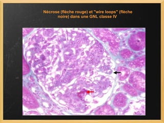 Nécrose (flèche rouge) et "wire loops" (flèche noire) dans une GNL classe IV  