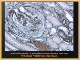 Rupture de la MBG et prolifération extra-capillaire dans une GNL classe IV (coloration argentique).   