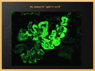 NL classe IV : IgG+++ en IF  