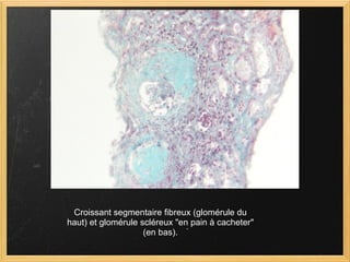 Croissant segmentaire fibreux (glomérule du haut) et glomérule scléreux "en pain à cacheter" (en bas). 