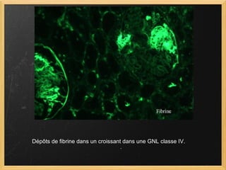 Dépôts de fibrine dans un croissant dans une GNL classe IV.  