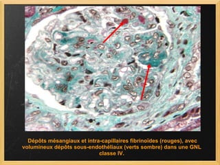   Dépôts mésangiaux et intra-capillaires fibrinoïdes (rouges), avec volumineux dépôts sous-endothéliaux (verts sombre) dans une GNL classe IV. 