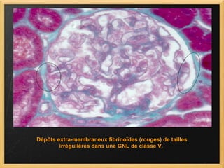 Dépôts extra-membraneux fibrinoïdes (rouges) de tailles irrégulières dans une GNL de classe V.  