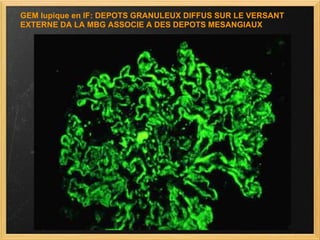 GEM lupique en IF: DEPOTS GRANULEUX DIFFUS SUR LE VERSANT EXTERNE DA LA MBG ASSOCIE A DES DEPOTS MESANGIAUX 
