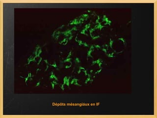 Dépôts mésangiaux en IF 