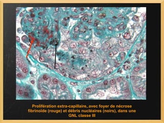 Prolifération extra-capillaire, avec foyer de nécrose fibrinoïde (rouge) et débris nucléaires (noirs), dans une GNL classe III 