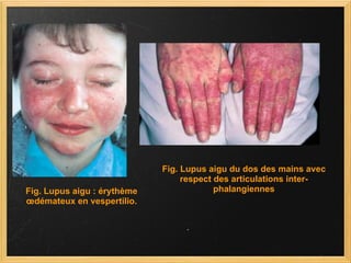 Fig. Lupus aigu : érythème œdémateux en vespertilio. Fig. Lupus aigu du dos des mains avec respect des articulations inter-phalangiennes 