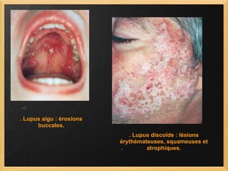 . Lupus aigu : érosions buccales. . Lupus discoïde : lésions érythémateuses, squameuses et atrophiques. 