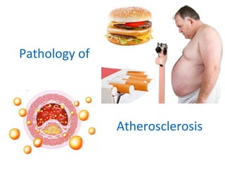 Pathology of
Atherosclerosis
 