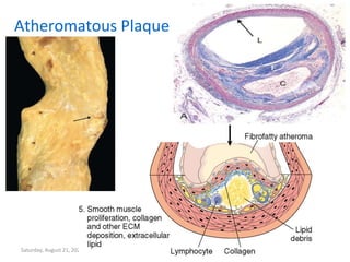 Saturday, August 21, 2021
Atheromatous Plaque
 