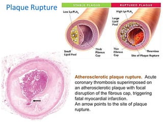 Atherosclerotic plaque rupture. Acute
coronary thrombosis superimposed on
an atherosclerotic plaque with focal
disruption of the fibrous cap, triggering
fatal myocardial infarction.
An arrow points to the site of plaque
rupture.
Plaque Rupture
 
