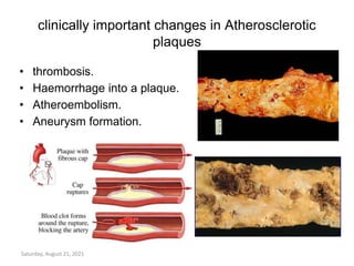 clinically important changes in Atherosclerotic
plaques
• thrombosis.
• Haemorrhage into a plaque.
• Atheroembolism.
• Aneurysm formation.
Saturday, August 21, 2021
 