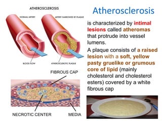 Atherosclerosis
is characterized by intimal
lesions called atheromas
that protrude into vessel
lumens.
A plaque consists of a raised
lesion with a soft, yellow
pasty gruelike or grumous
core of lipid (mainly
cholesterol and cholesterol
esters) covered by a white
fibrous cap
FIBROUS CAP
NECROTIC CENTER MEDIA
 
