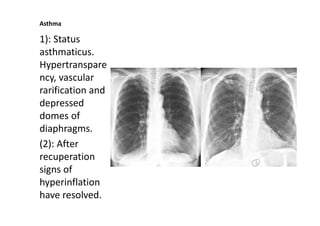 Rarification 17A. CHRONIC OBSTRUCTIVE PULMONARY DISEASES(COPD).pdf