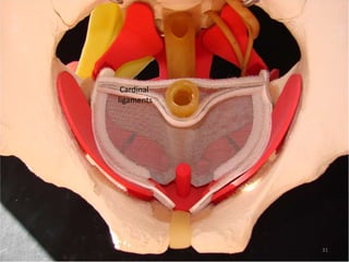 Cardinal
ligaments
31
 