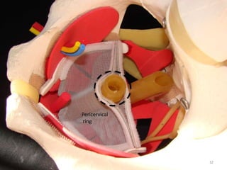 Pericervical
ring
32
 