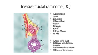 Comprehensive Overview of Pneumoconiosis and Invasive Ductal Carcinoma ...