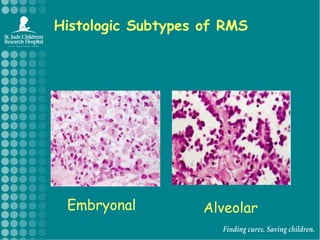Histologic Subtypes of RMSEmbryonalAlveolar