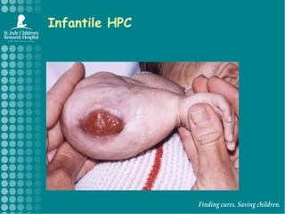Infantile HPC