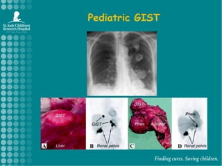 Pediatric GIST