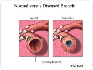 Normal versus Diseased Bronchi
 
