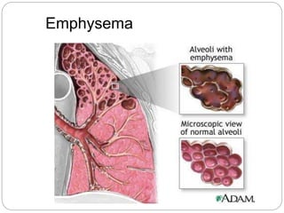 Emphysema
 