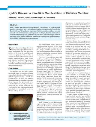 Journal of The Association of Physicians of India ■ Vol. 64 ■ July 2016 81
Kyrle’s Disease: A Rare Skin Manifestation of Diabetes Mellitus
A Pandey1
, Keshri S Yadav2
, Gaurav Singh2
, M Chaturvedi3
1
Assistant Professor, 2
Junior Resident, 3
Professor, P.G. Department of Medicine, S.N. Medical College, Agra, Uttar Pradesh
Received: 13.06.2015; Revised: 19.08.2015; Accepted: 27.08.2015
Introduction
Kyrle’s disease or hyperkeratosis
follicularis et parafollicularis et
cuten penetrance was first described
in 1916 by J. Kyrle as hyperkeratotic
verrucous papules and nodules in
diabetic women.1
The disease is most
closely associated with renal failure
and diabetes mellitus. The common
pathophysiological principle in these
disorders is transepidermal elimination
of dermal substances.
Case Report
We report a case of Kyrle’s disease
involving lower extremities (gluteal
region, back of thighs and lateral aspect
of both legs) for the last 1 month. The
patient was a 50 year old diabetic
female and was on irregular treatment
since 5 years. She presented to us
with breathlessness and generalized
anasarca, her blood pressure was
170/90 mmHg and she had undergone
hemodialysis 1 month back in view of
chronic kidney disease.
elimination of necrobiotic basophilic
collagen, eosinophilic elastic fibres and
degenerated follicular contents with or
without collagen or elastic fibres is seen
in reactive perforating collagenosis,
elastosis perforans serpiginosa and
perforating follicularis respectively.1
In Kyrle’s disease there is transdermal
elimination of keratin with no collagen
or elastic fibres.1
Kyrle’s disease has been proposed
to be genetically determined disease
with onset during adulthood mostly
during 30-50 years of age but cases
as early as 5 years and as late as 75
years have been reported. The mode of
inheritance is not clearly understood,
it can be autosomal dominant or
recessive.2
A case of familial Kyrle’s
disease has been reported in a 30 year
old male with onset at 5 years of age
with asymptomatic lesions on both
upper and lower extremity, upper
back, palms and soles. Involvement of
cornea, conjunctiva, palms and soles
along with dental anomalies was noted
in all the affected family members in an
autosomal dominant pattern.3
Although the exact etiology of
Kyrle’s disease is unknown, it has
been found to be associated with
renal disorders, uremic patients
on dialysis, diabetes mellitus, liver
disease and paraneoplastic syndrome
in multiple myeloma. It has also
been associated with other conditions
including tuberculosis, pulmonary
aspergillosis, scabies, atopic dermatitis,
AIDS, neurodermatitis and malignancy
and endocrinal disorders.1,3
Kyrle’s disease is characterized by
hyperkeratotic papules and nodules
with a central keratotic plug mostly
located in lower limbs.2,4
Pruritis may or
may not be associated with the lesion.
These lesions have marked propensity
to involve calf and tibial region and
posterior thigh. The exact pathogenesis
of Kyrle’s disease is not clear. However
it has been proposed that abnormal
keratinization is responsible for the
Abstract
Kyrle’s disease is a rare skin disorder which is characterized by hyperkeratotic
papules and nodules with a central keratotic plug mostly located in lower limbs.
Exact etiology of Kyrle’s disease is unknown, but its association has been reported
sparsely with renal disorders, uremic patients on dialysis, diabetes mellitus, liver
disease and paraneoplastic syndromes, tuberculosis and some fungal diseases.
We report Kyrle’s disease in a middle aged female suffering from diabetes mellitus
with diabetic nephropathy on hemodialysis.
She developed severe pruritic
papulonodular lesions on her legs
which progressed to involve both
the thighs and the gluteal region.
The patient had no family history of
diabetes and no other member of family
had similar complaints.
Physical examination revealed
multiple well demarcated papular
lesions of variable sizes (2-5 mm);
lesions were asymmetrically distributed
over gluteal region lateral side of legs
and back of thighs. The lesions were
papulonodular and hyper pigmented
(purplish blue in colour) with central
keratin plug (Figure 1). They were
non tender and firm in consistency.
Investigations (blood sugar, blood
urea, serum creatinine, serum Na+,
and K+ ,USG abdomen) were done
and she was found to have developed
diabetic nephropathy (CKD stage 5).
Her HbA1C was 10.5% indicating very
poor glycemic control. Viral markers
(HIV, HBsAg, anti HCV) were negative.
Diagnosis of Kyrle’s disease
was confirmed on punch biopsy
which showed keratotic and partly
parakeratotic plug invaginating the
dermis.
Discussion
Kyrle’s disease is a rare skin disorder
representing a subtype of perforating
disorders dermatosis which involves
transepithelial elimination of dermal
structures. The perforating dermatosis
has been classified on the basis of nature
of substance eliminated.1
Tranepidermal
Fig 1: 	 Papulonodular and hyper-
pigmented Kyrle’s lesion with
central keratin plug on lateral
and posterior aspect of thigh
and gluteal region
 