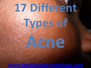 17 Different
Types of
Acne
www.DarkSkinDermatology.com
 
