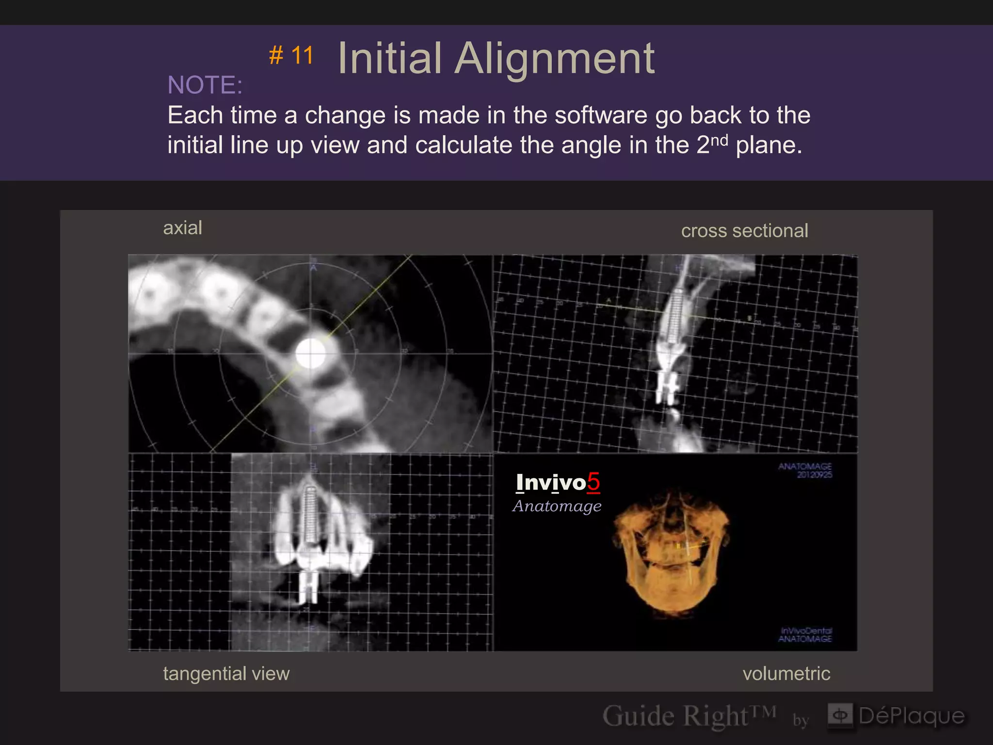 NOTE:
            # 11   Initial Alignment
Each time a change is made in the software go back to the
initial line up view and calculate the angle in the 2nd plane.


axial                                            cross sectional




                                  Invivo5
                                 Anatomage


                                 Invivo5
                                 Anatomage




tangential view                                         volumetric
 