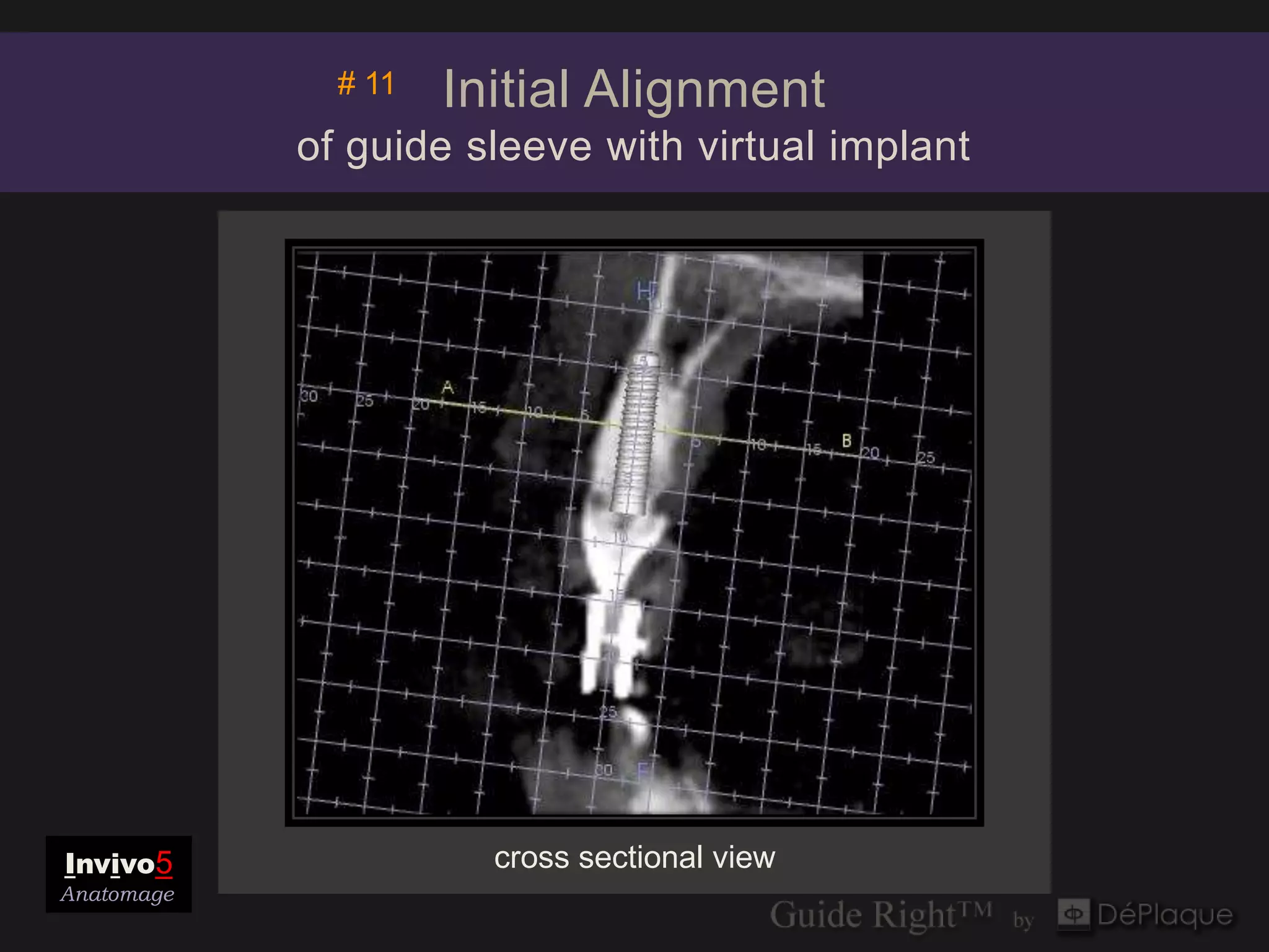 # 11   Initial Alignment
            of guide sleeve with virtual implant




Invivo5                cross sectional view
Anatomage
 