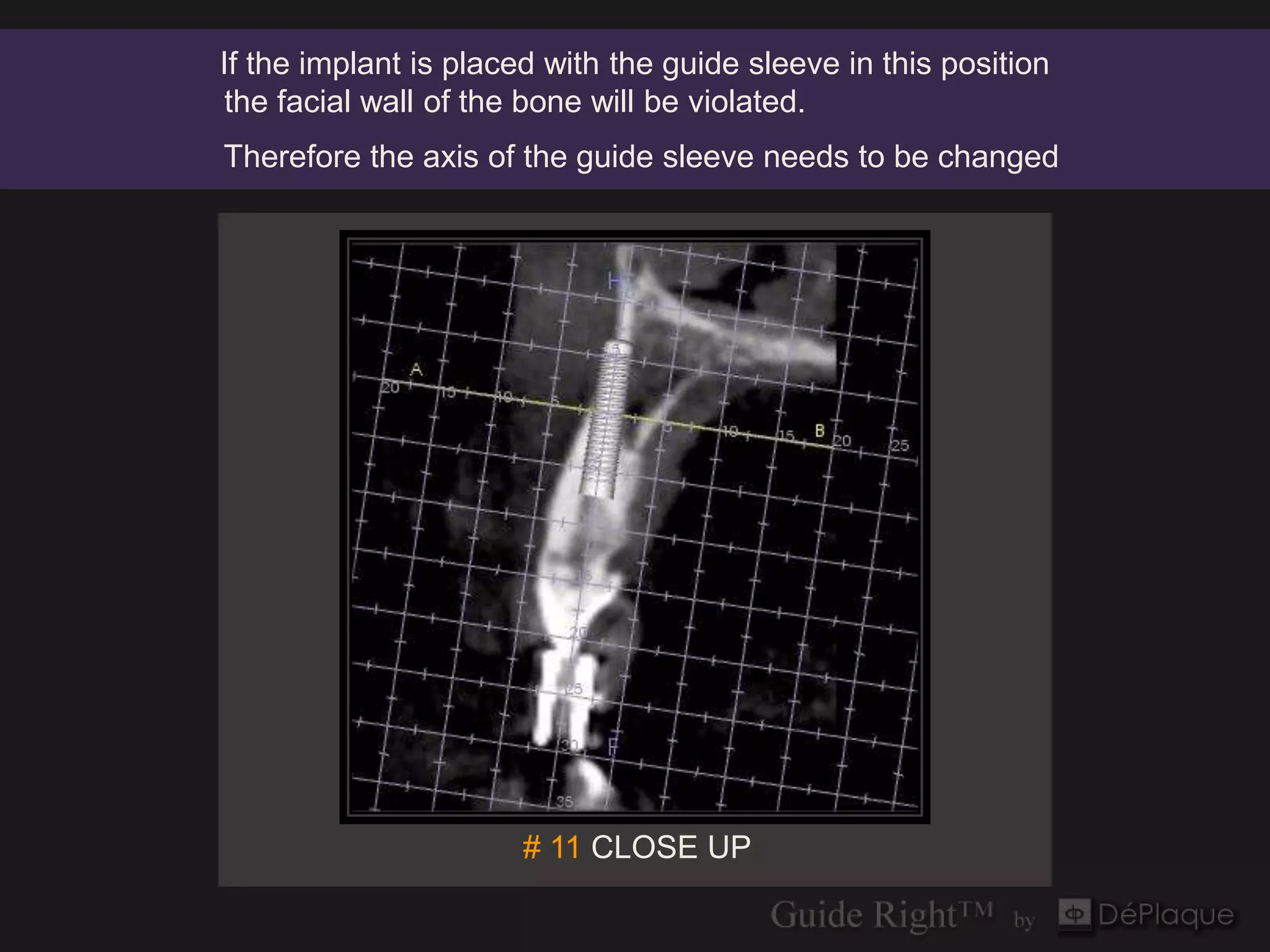 If the implant is placed with the guide sleeve in this position
 the facial wall of the bone will be violated.
Therefore the axis of the guide sleeve needs to be changed




                       # 11 CLOSE UP
 