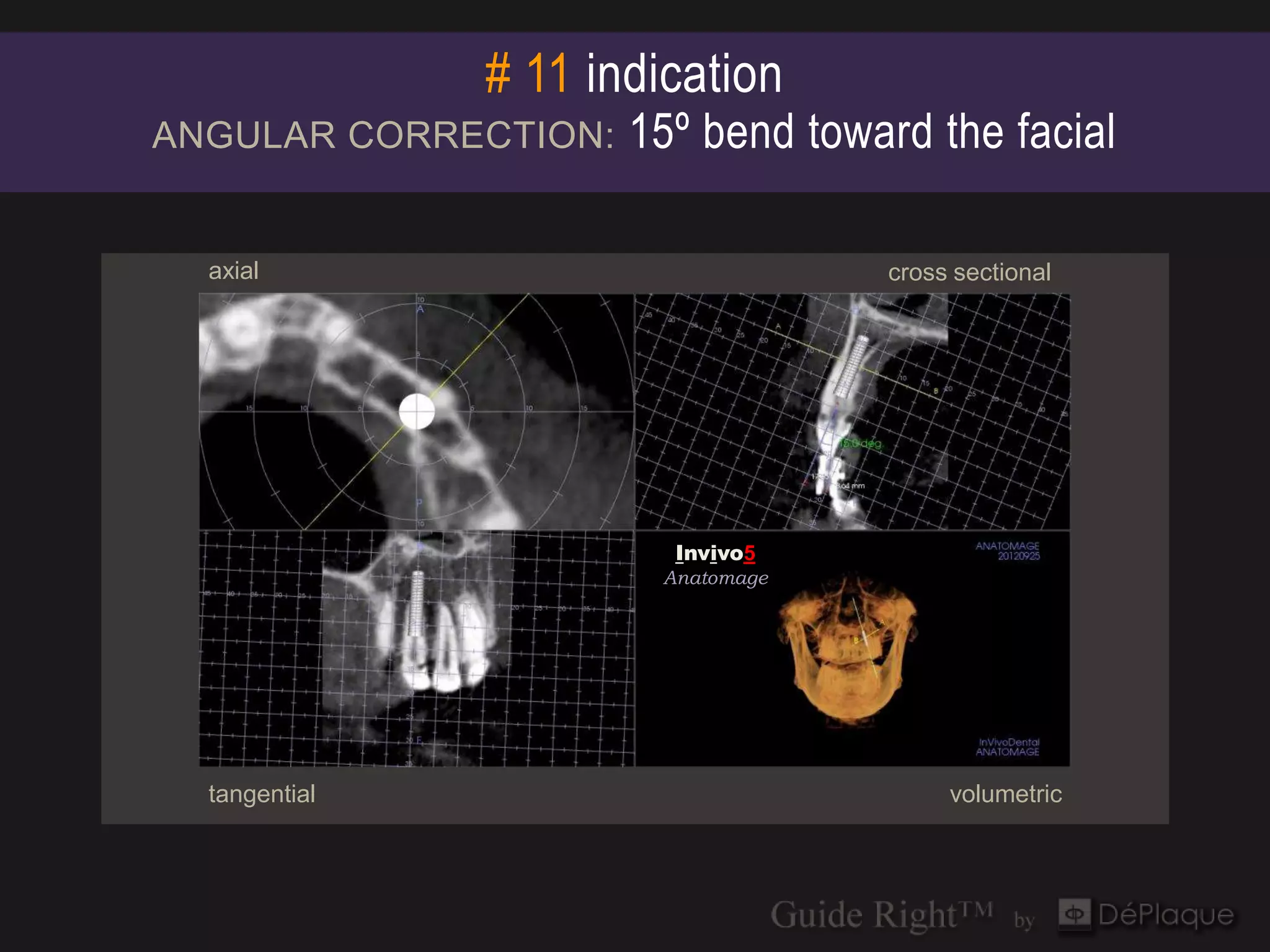 # 11 indication
ANGULAR CORRECTION:   15º bend toward the facial

  axial                            cross sectional




                        Invivo5
                        Invivo5
                       Anatomage
                       Anatomage




  tangential                            volumetric
 