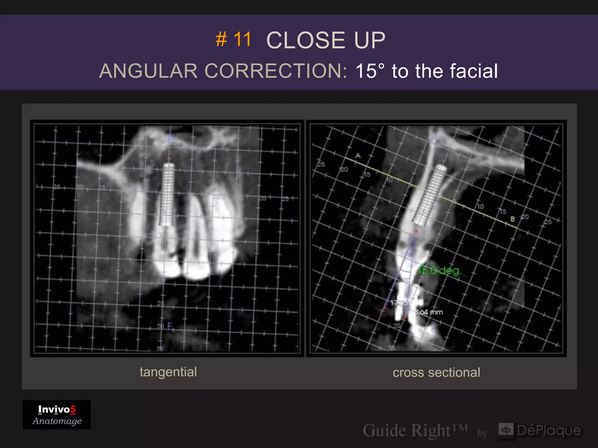 # 11 CLOSE UP
            ANGULAR CORRECTION: 15° to the facial




               tangential              cross sectional

 Invivo5
Anatomage
 