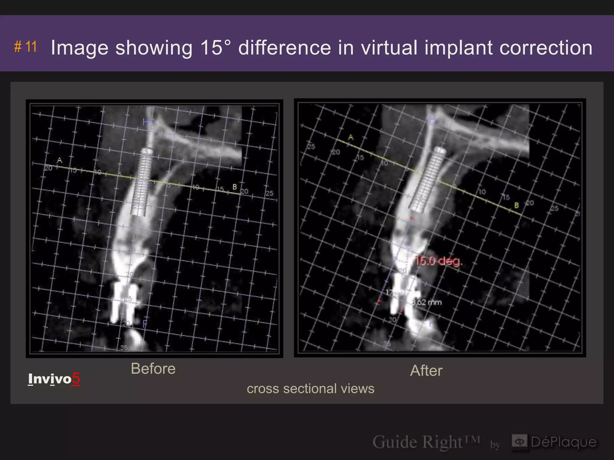 # 11   Image showing 15° difference in virtual implant correction




               Before                              After
  Invivo5
                           cross sectional views
 