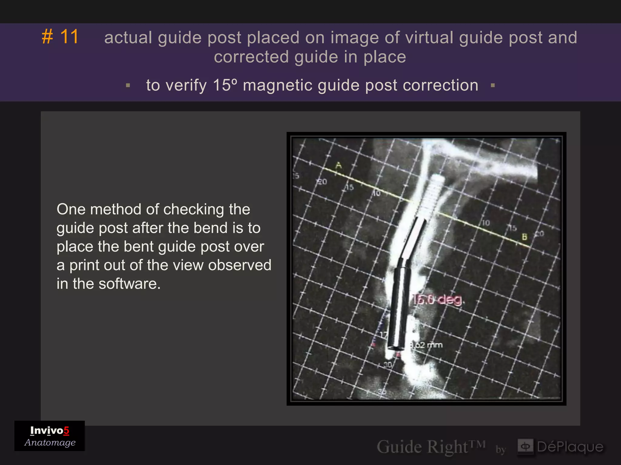 # 11     actual guide post placed on image of virtual guide post and
                          corrected guide in place
               ▪ to verify 15º magnetic guide post correction ▪




     One method of checking the
     guide post after the bend is to
     place the bent guide post over
     a print out of the view observed
     in the software.




 Invivo5
Anatomage
 