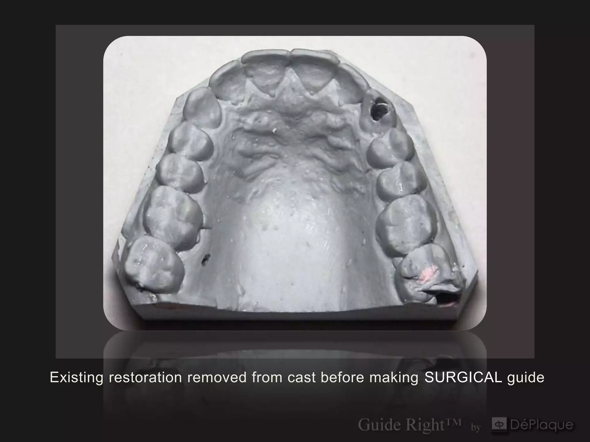 Existing restoration removed from cast before making SURGICAL guide
 