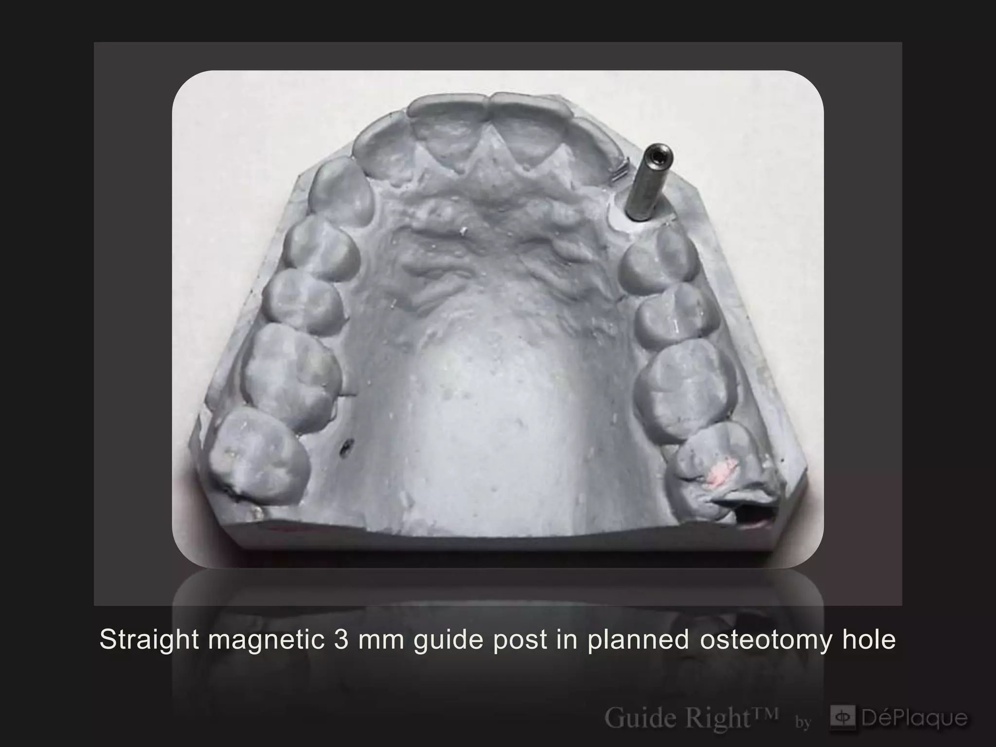 Straight magnetic 3 mm guide post in planned osteotomy hole
 