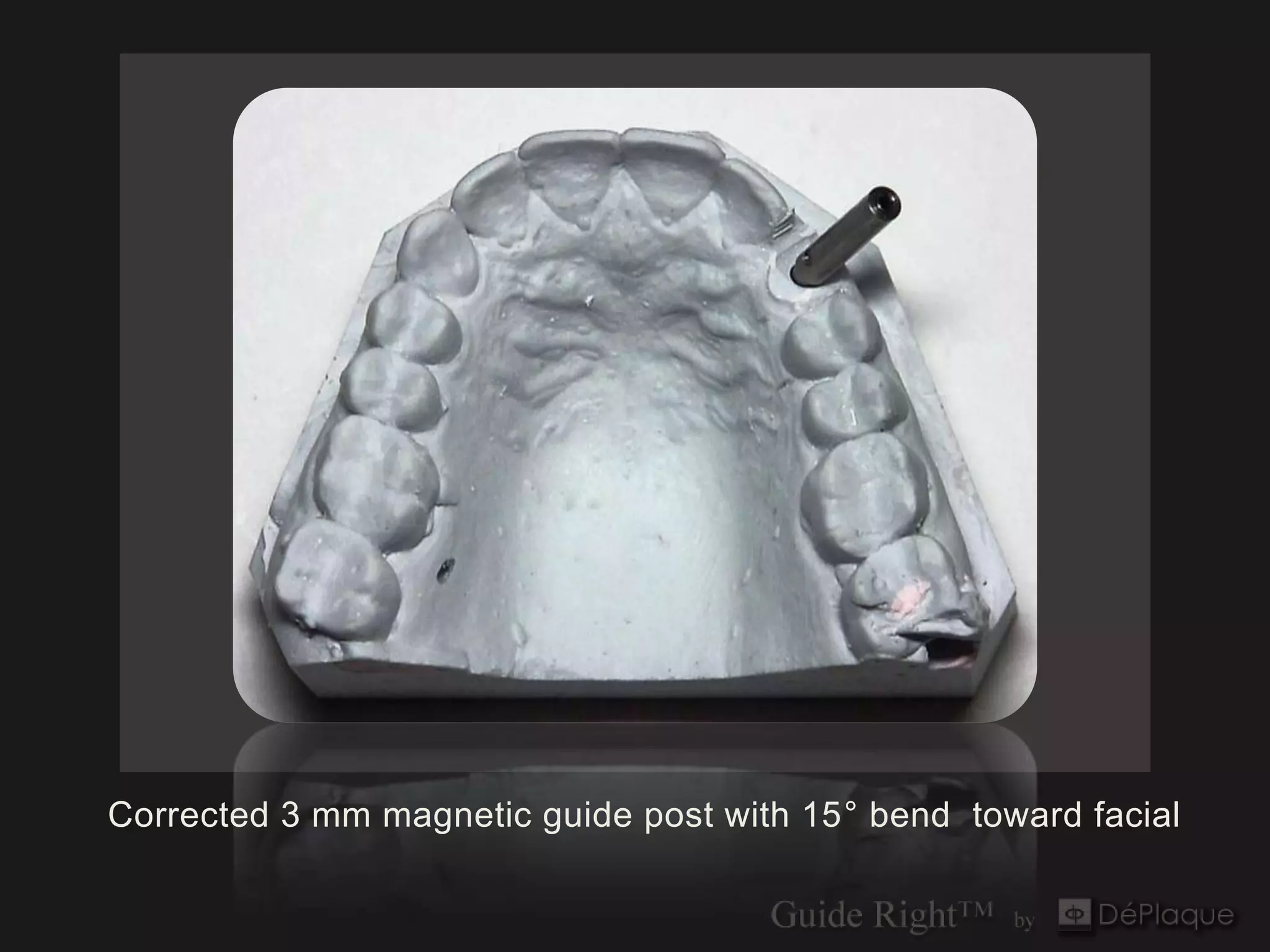 Corrected 3 mm magnetic guide post with 15° bend toward facial
 