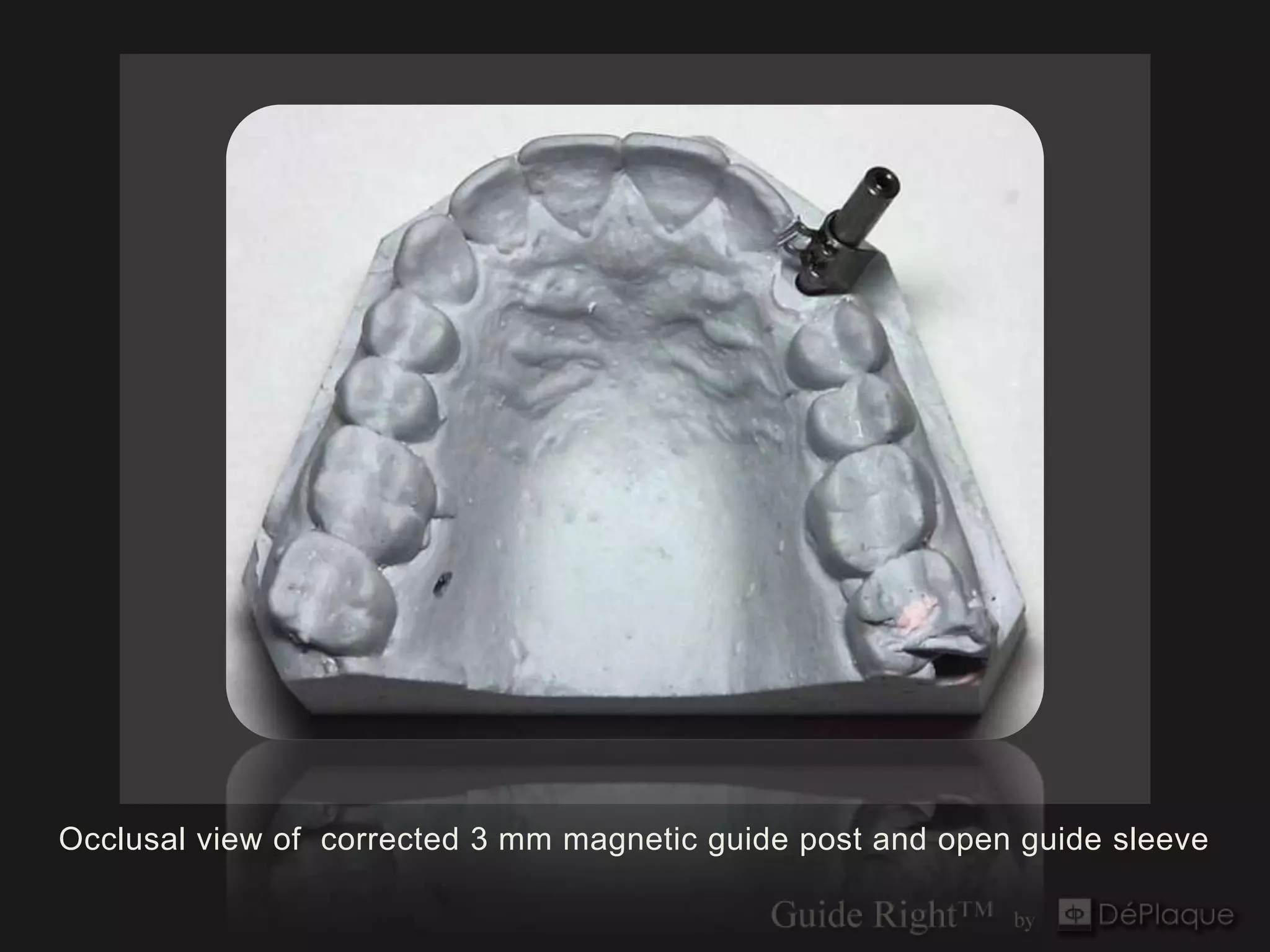 Occlusal view of corrected 3 mm magnetic guide post and open guide sleeve
 