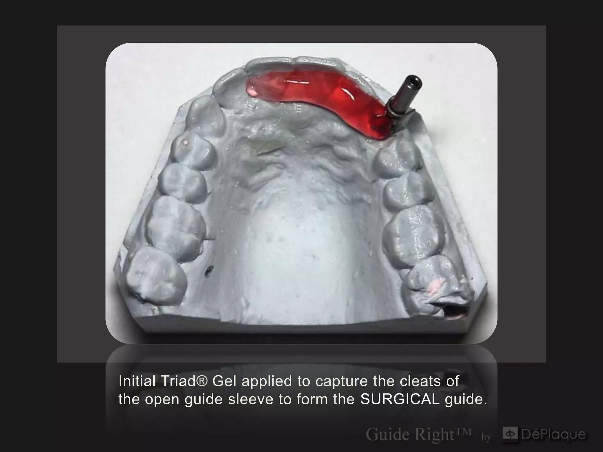 Initial Triad® Gel applied to capture the cleats of
the open guide sleeve to form the SURGICAL guide.
 