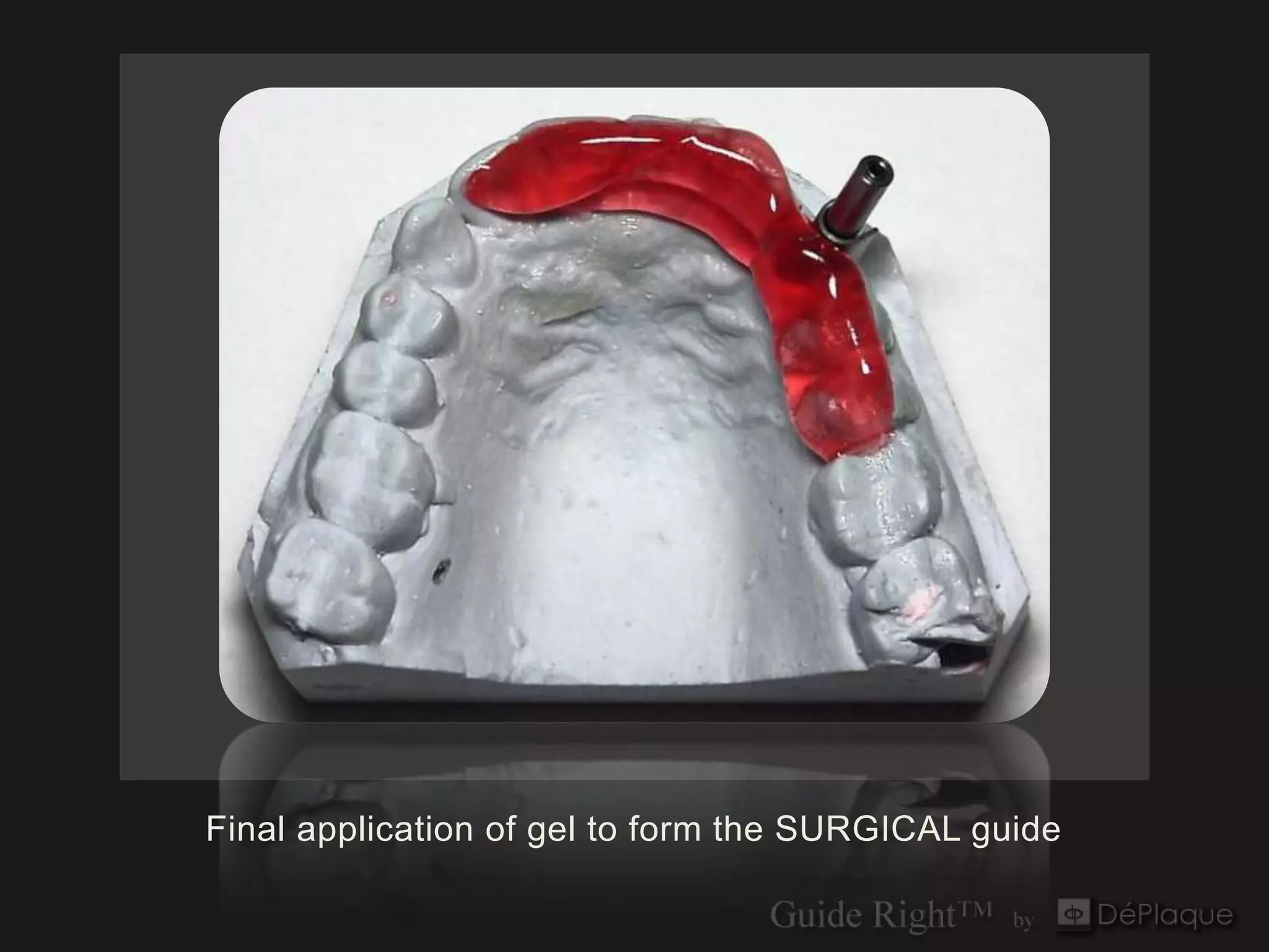 Final application of gel to form the SURGICAL guide
 